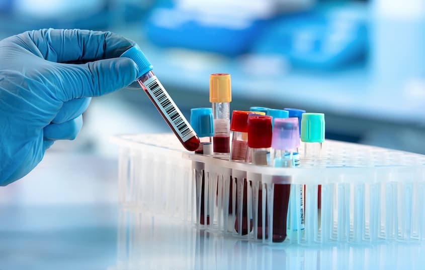 First Alzheimer’s Blood Test Cleared by FDA